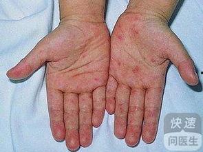 手足口病吃瓜,手足口病防控攻略